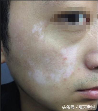 治面部白癜风最有效的方法,脸部有白癜风应该用什么护肤