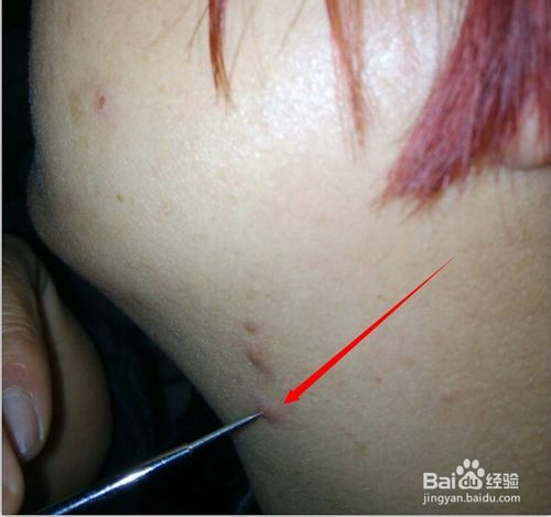 怎样消除青春痘和粉刺最快的方式,如何有效祛除青春痘