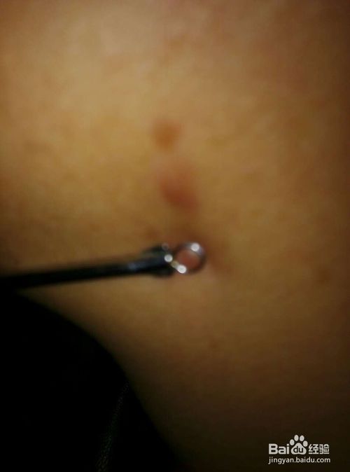 怎样消除青春痘和粉刺最快的方式,如何有效祛除青春痘