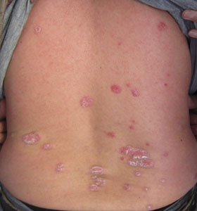 长期保湿有助于牛皮癣的恢复吗,有关牛皮癣常识的详细介绍