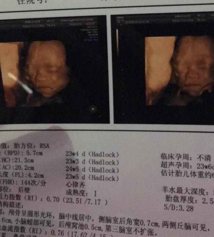 23周四维结果绕颈一圈怎么办,23周6天四维
