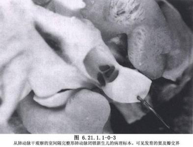 新生儿肺动脉闭锁治疗方案,儿童肺动脉闭锁能自己治好吗