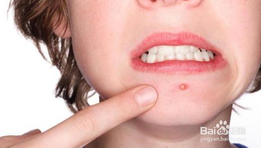 怎样消除青春痘和粉刺最快的方式,如何有效祛除青春痘