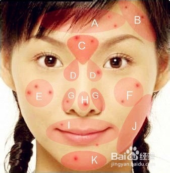 怎样消除青春痘和粉刺最快的方式,如何有效祛除青春痘