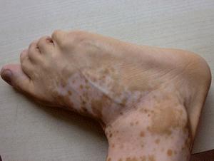 308治疗白癜风需要多久？效果很好吗？