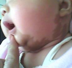 宝宝面部胎记,宝宝各种胎记对照表