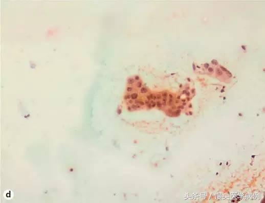 卵巢肿瘤穿刺活检结果,卵巢囊肿穿刺从哪穿刺