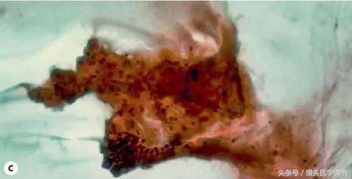 卵巢肿瘤穿刺活检结果,卵巢囊肿穿刺从哪穿刺