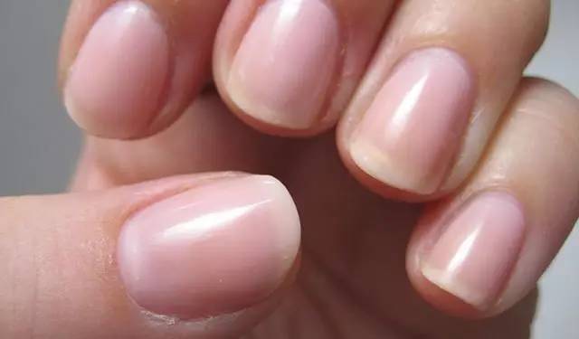 指甲盖凹陷还伴有月牙过大,手指上的月牙过大是什么原因