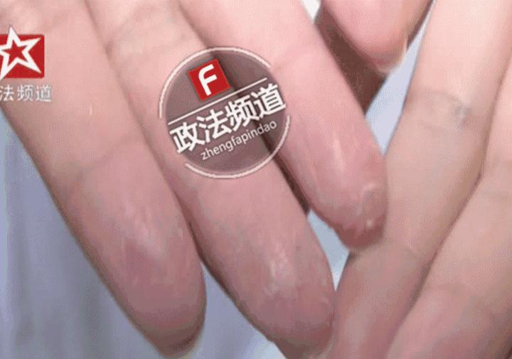 蹇冪柤鍖绘姢浜哄憳鐨勬墜,蹇冪柤绮楃硻鐨勬墜