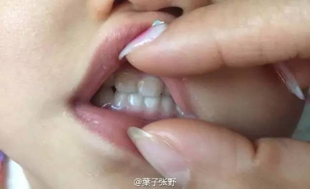 小孩牙齿不齐换牙后会变好吗,为什么换牙后牙齿不齐