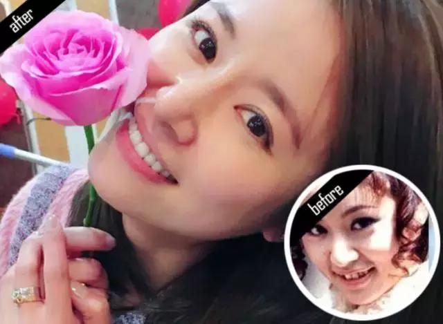 林允的牙怎么又恢复了,林允回应脸型变化她又变脸了吗