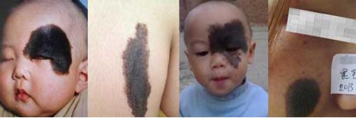 宝宝面部胎记,宝宝各种胎记对照表