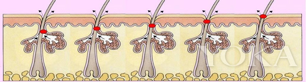 去闭口美容项目,美容护肤问题解答