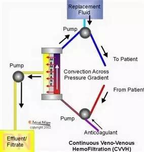 连续性血液净化设备,连续性血液净化技术操作视频