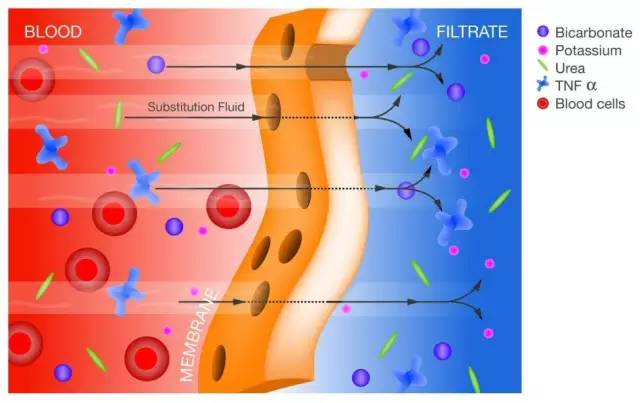 连续性血液净化设备,连续性血液净化技术操作视频