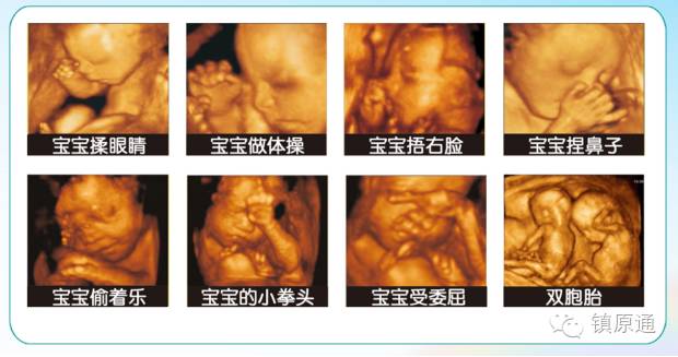 镇原协和医院四维彩超怎么样,庆阳市第一人民医院四维彩超