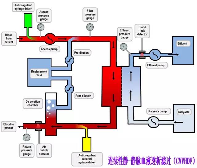 连续性血液净化设备,连续性血液净化技术操作视频