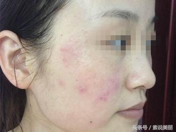 用了激素产品脸上有什么症状,脸上用了有激素的化妆品怎么恢复