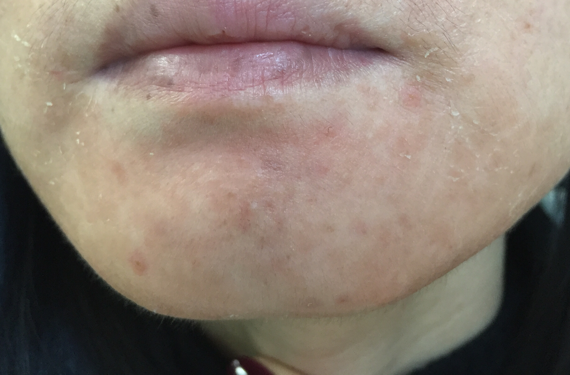 果酸治疗青春痘有副作用吗,青春痘药膏推荐无副作用