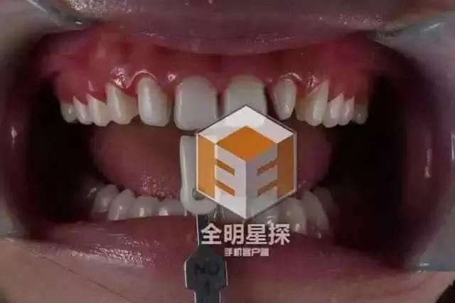 林允的牙怎么又恢复了,林允回应脸型变化她又变脸了吗