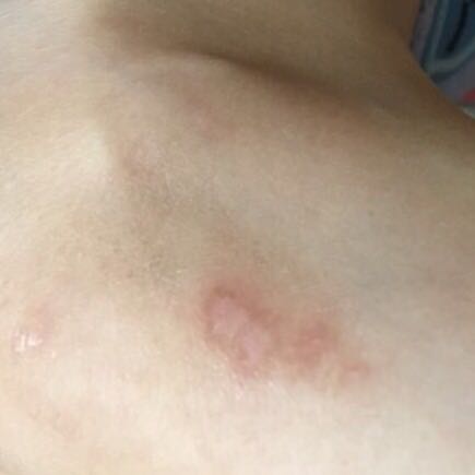 推荐便宜好用的祛疤膏,你有什么祛疤膏推荐吗