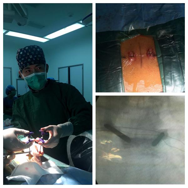 陈旧胸椎压缩性骨折治好的案例,年轻人胸椎压缩性骨折的康复患者