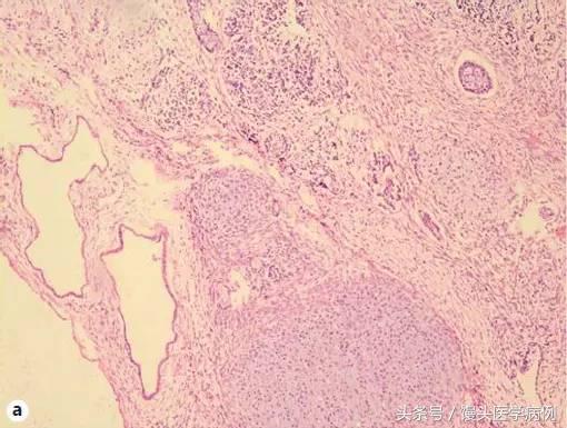 卵巢肿瘤穿刺活检结果,卵巢囊肿穿刺从哪穿刺