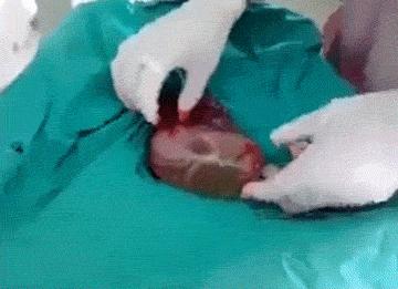 破水流一点没有宫缩去医院吗,破水后医院未关注羊水有责任吗