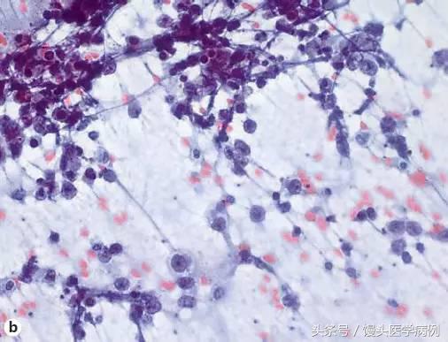 卵巢肿瘤穿刺活检结果,卵巢囊肿穿刺从哪穿刺