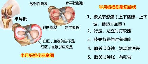 半月板平时关注事项怎样恢复更快,半月板检查需要关注什么