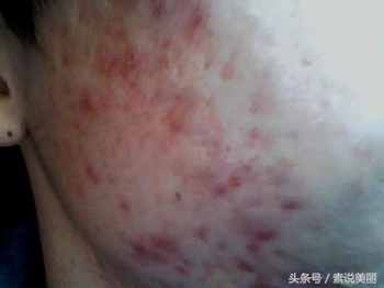 用了激素产品脸上有什么症状,脸上用了有激素的化妆品怎么恢复