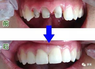 林允整牙却像整容？她是真的又整了啊！