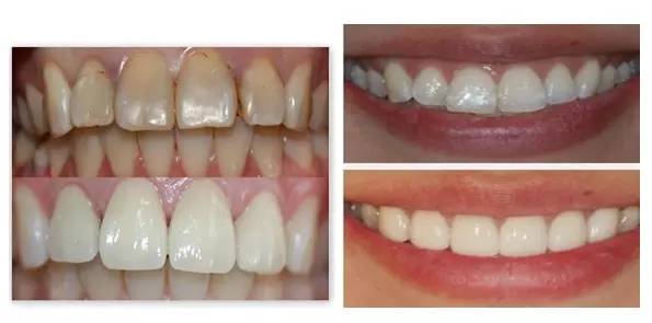 林允整牙却像整容？她是真的又整了啊！