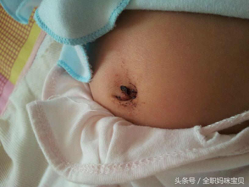 婴儿肚脐一直出血怎么回事,22天的宝宝肚脐出血是怎么回事