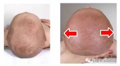 没有后脑勺可以留油头吗,有些人没有后脑勺