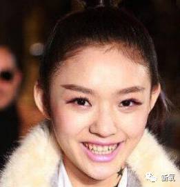 林允整牙却像整容？她是真的又整了啊！