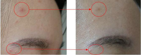 右脸长痘怎么快速有效的解决,婴儿右脸长痘痘是什么原因