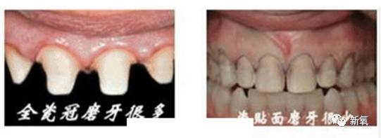 林允整牙却像整容？她是真的又整了啊！