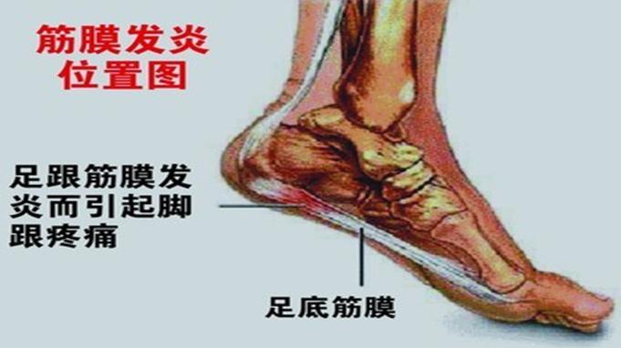 脚后跟摸着不疼踩着就疼是啥原因,走路多脚后跟疼是什么原因引起的