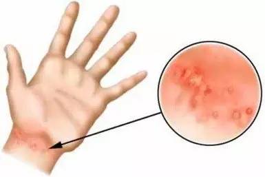 GET这14条，你就可以和疥疮拜拜了