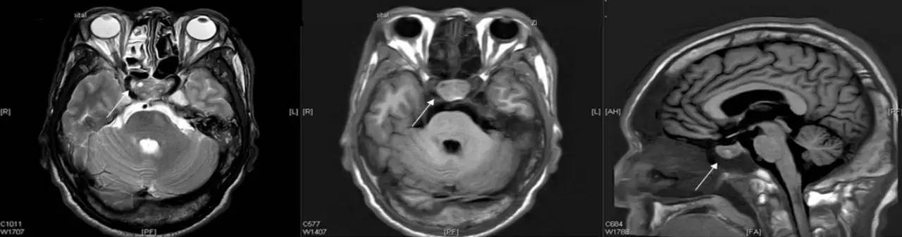 与肢端肥大有关的病症,肢端肥大症的别名