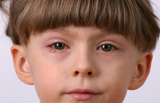 眼结膜炎怎么舒缓,婴幼儿细菌性结膜炎怎么治愈