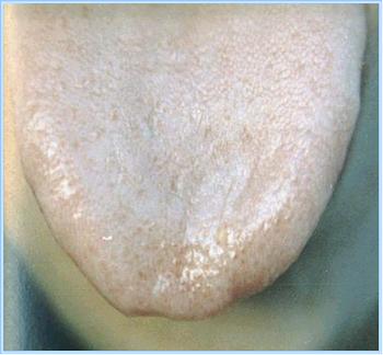 舌头有突起是什么病,舌头有这些表现或是疾病征兆