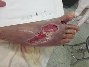 糖尿病并发症一旦产生，药物治疗很难逆转