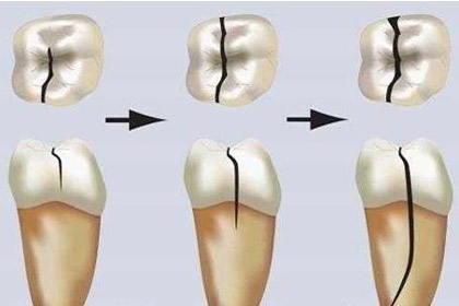 牙齿骨折后能自然愈合吗,骨折可以彻底痊愈吗
