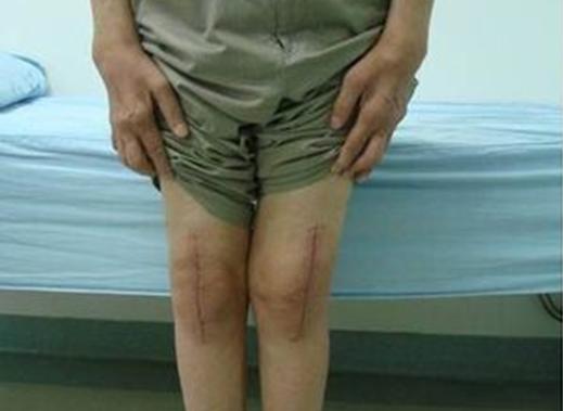 退行性膝关节炎能治好吗,退行性膝关节炎最好治疗方法