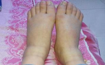 孕妇脚肿是怎么缓解呢,孕妇脚肿怎么办最有效的方法