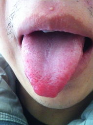 舌头有突起是什么病,舌头有这些表现或是疾病征兆