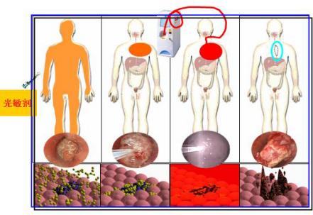 南通光动力治疗癌症靠谱吗,光动力科普视频